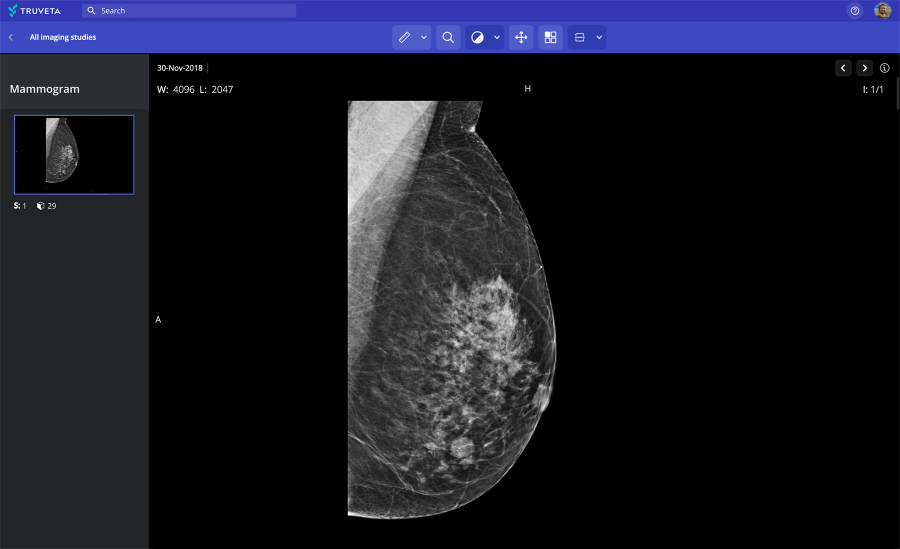 Mammogram oncology research RWD RWE cancer imaging full patient journey cancer screening