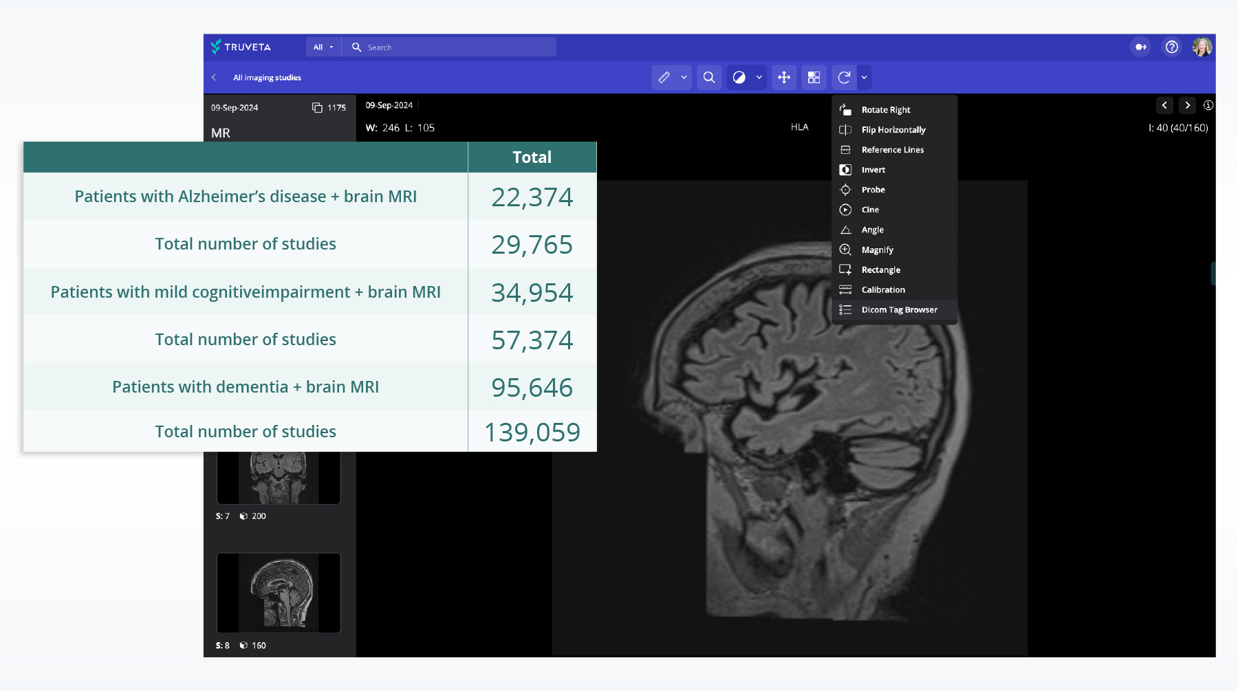 AFR-Alzheimers-graphic Screenshot of a brain MRI in the Truveta platform with overlaid table showing the number of imaging studies for Alzheimer’s, mild cognitive impairment, and dementia patients. Includes counts such as 22,374 patients with Alzheimer’s disease + brain MRI and 139,059 total dementia-related MRI studies.