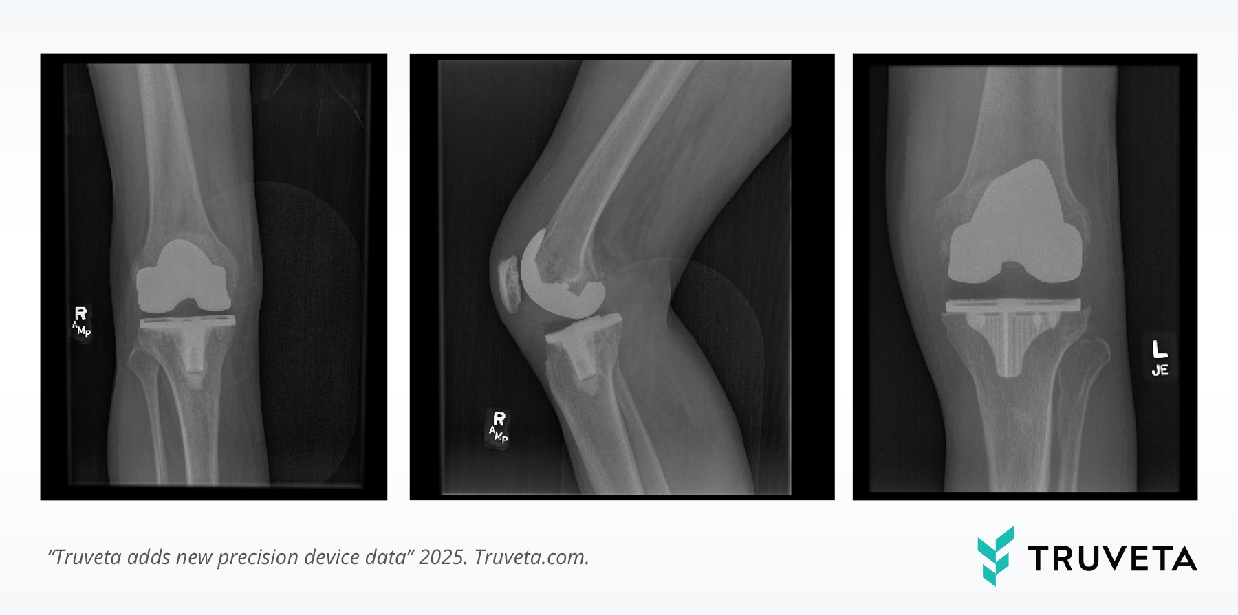 Device-Announcment-Knee-Xray RWD RWE medical device research safety effectiveness HEOR EHR chargemaster unique device identifier ADT ICU procedure logs